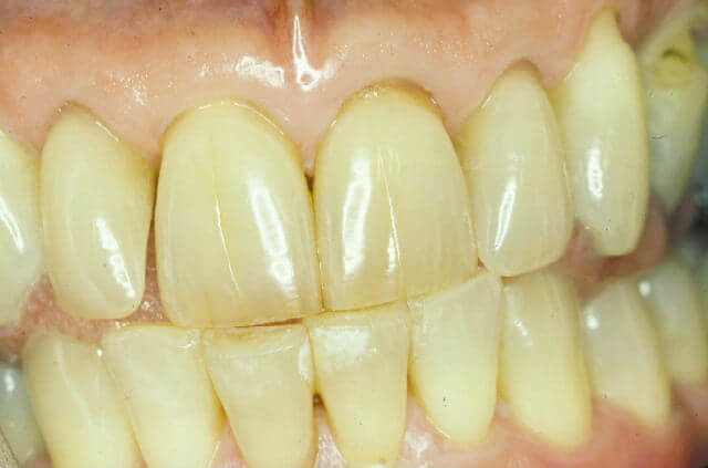 simple trick to turn yellow teeth white