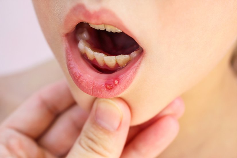 canker sore treatment