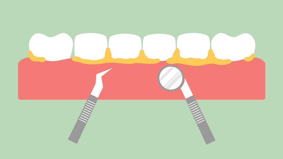 Does a teeth cleaning hurt? What should you expect?