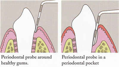 periodontal probe