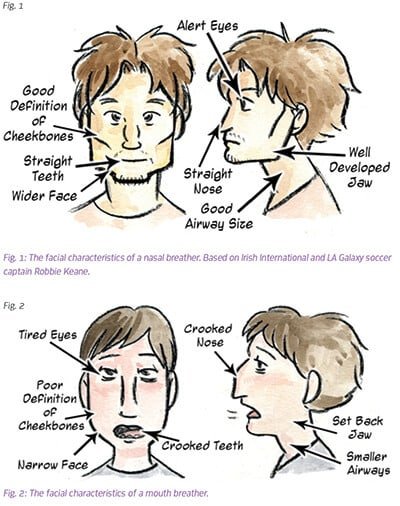 development of mouth breathers