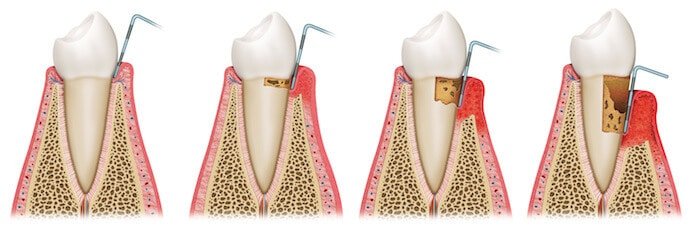 gum disease progression