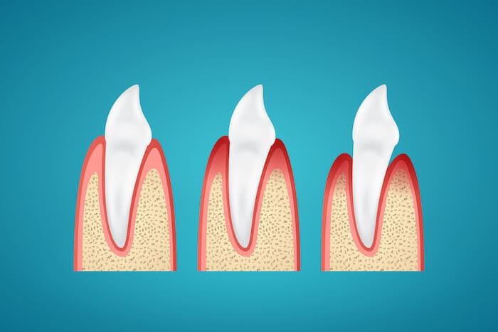 gum inflammation