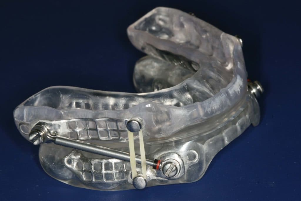 sleep apnea mouth guard