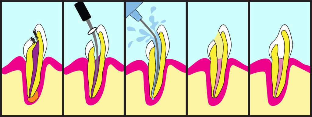 root canal procedure, root canal illustration, what to expect during a root canal