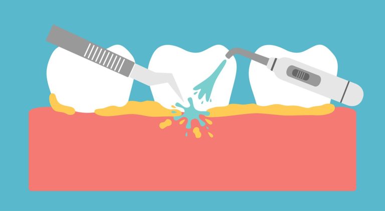 how to make teeth cleanings less painful