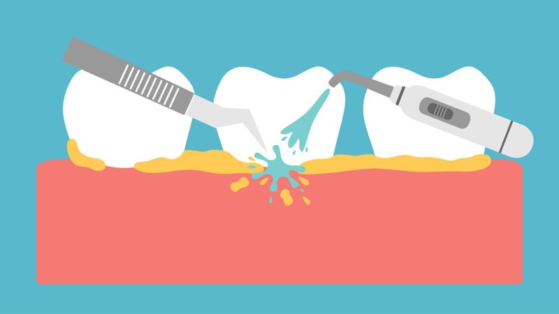 how to make teeth cleanings less painful