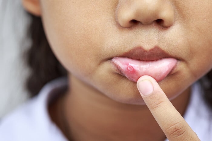 cold sore inside mouth