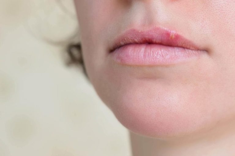 Cold Sores Vs Canker Sores Why You Should Know The Difference 