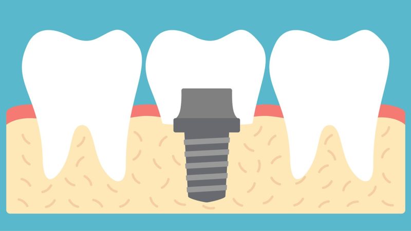 dental implant
