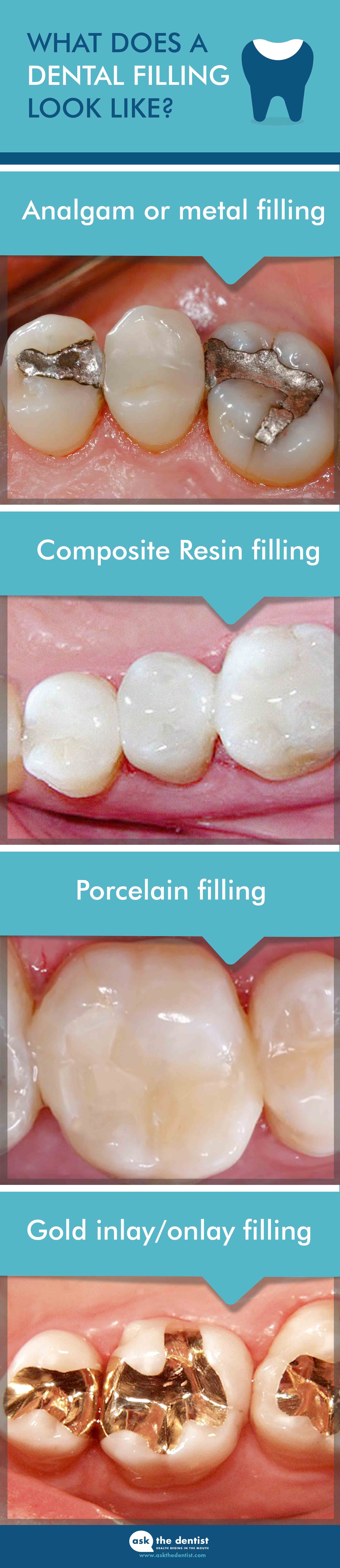 dental fillings