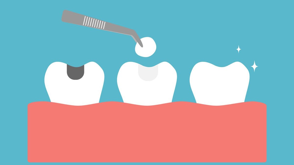 When You Need a Dental Filling + What to Expect