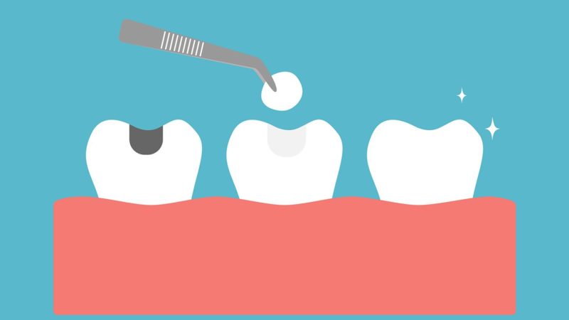 dental filling