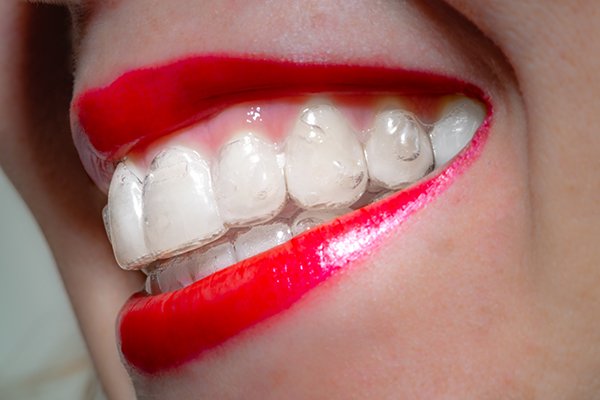 Invisalign Cost Insider Tips: How to Save Money on Invisalign