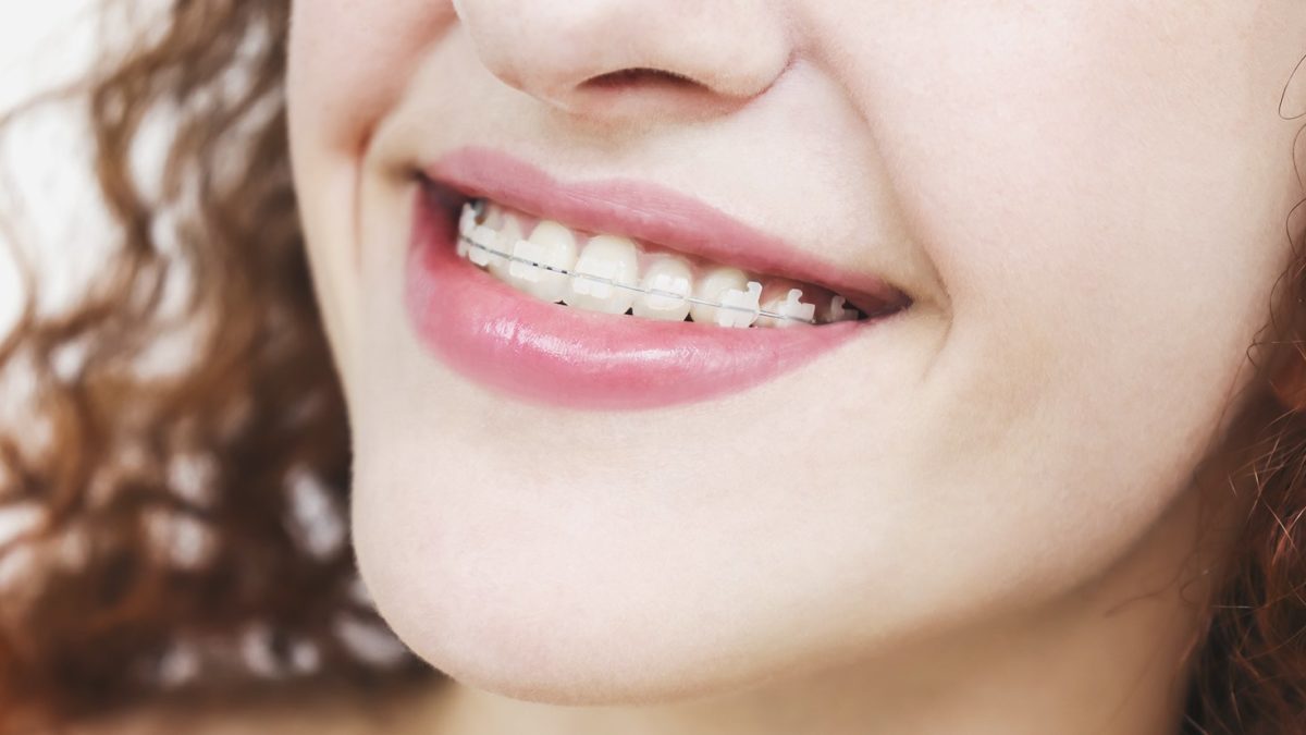 Ceramic Braces Vs. Metal Braces [Plus Costs & FAQs] - Ask The Dentist