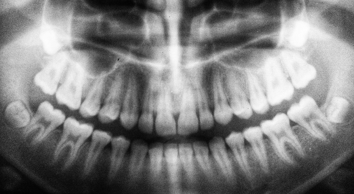 Invisible Risks Of X Rays Are Dental X Rays Safe Ask The Dentist