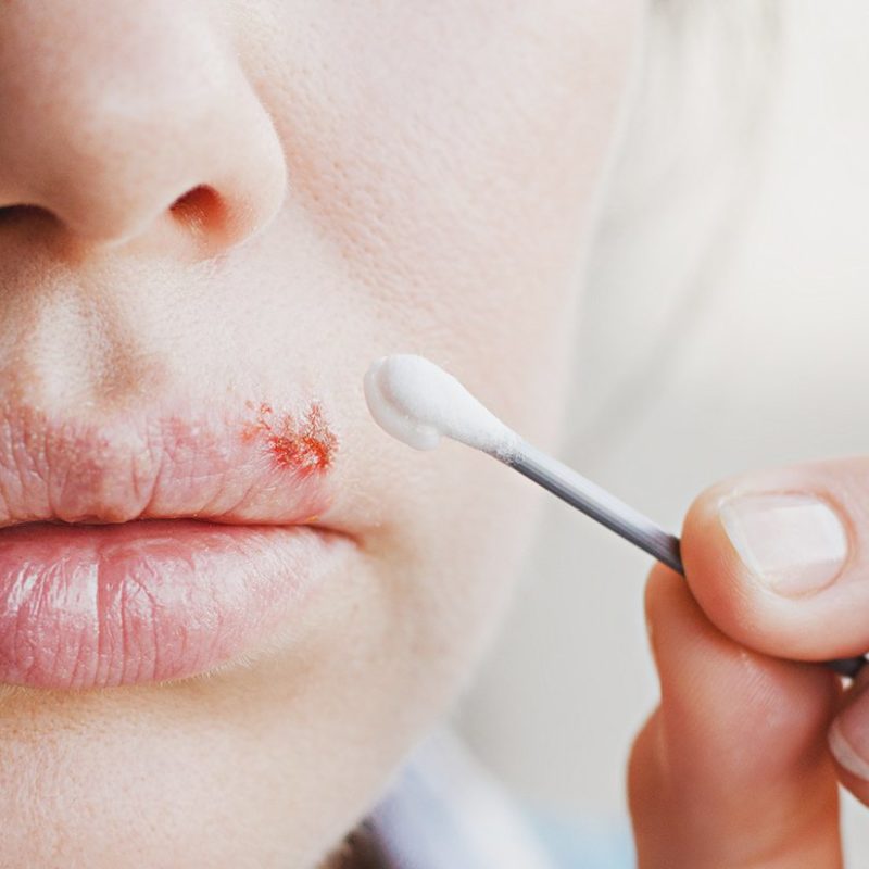 Do Certain Toothpastes Cause Canker Sores? Ask the Dentist