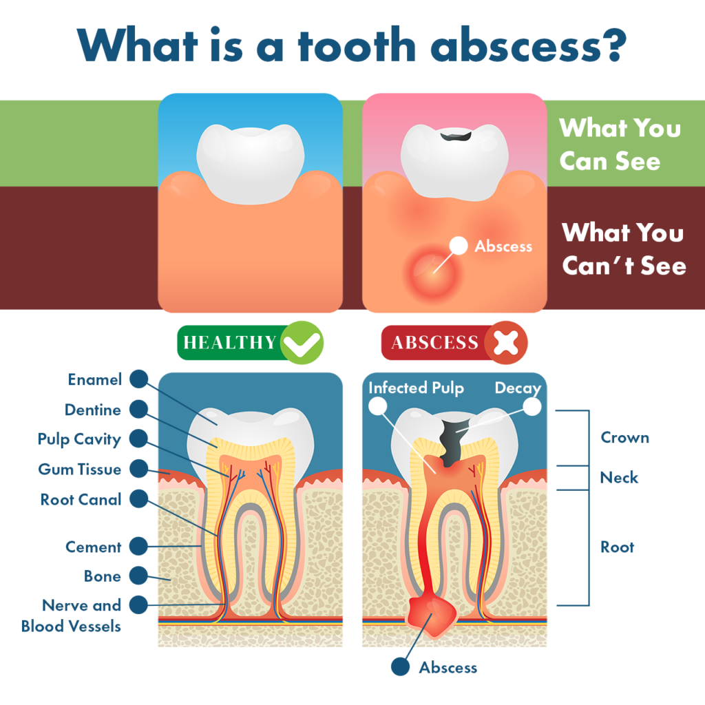 Tooth Abscess Symptoms Remedies Complications Prevention