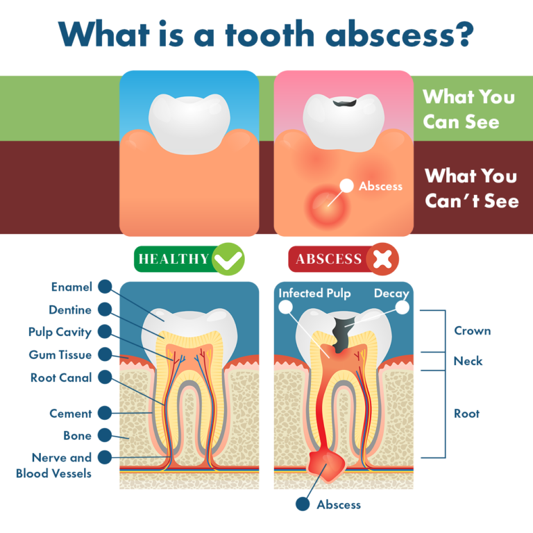Tooth Abscess Symptoms, Remedies, Complications & Prevention