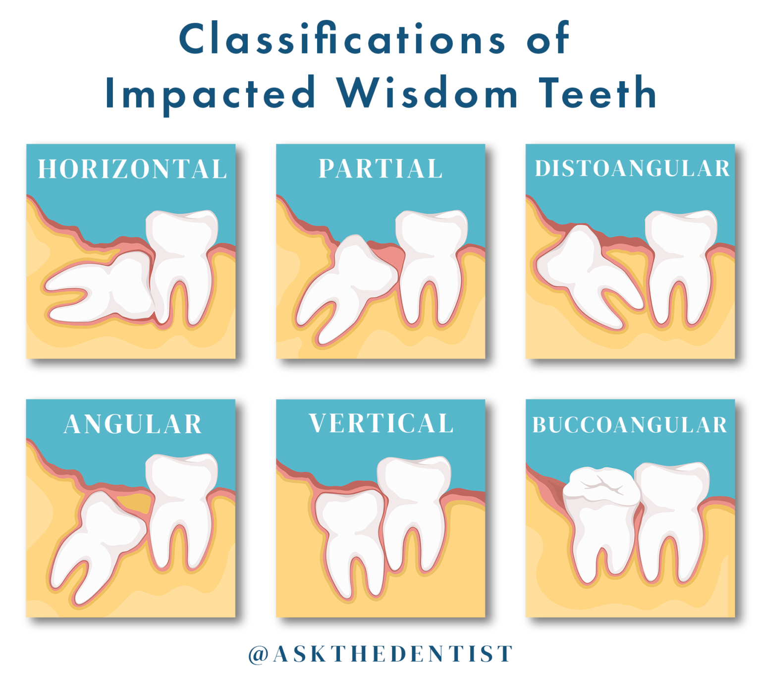 Wisdom Teeth Pictures, Symptoms, Surgery, & Pain Relief Ask the Dentist