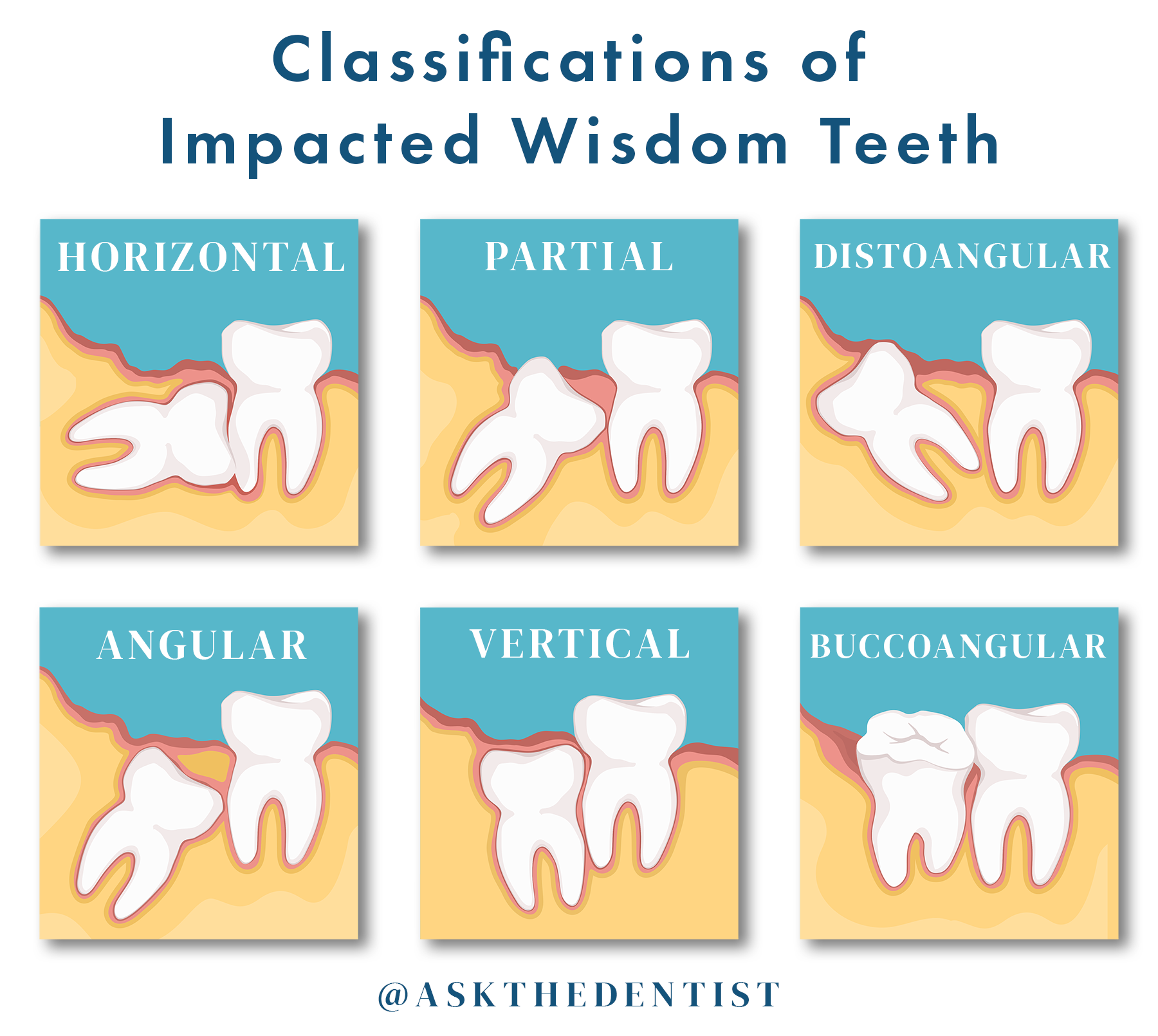 Classifications of Impacted Wisdom Teeth