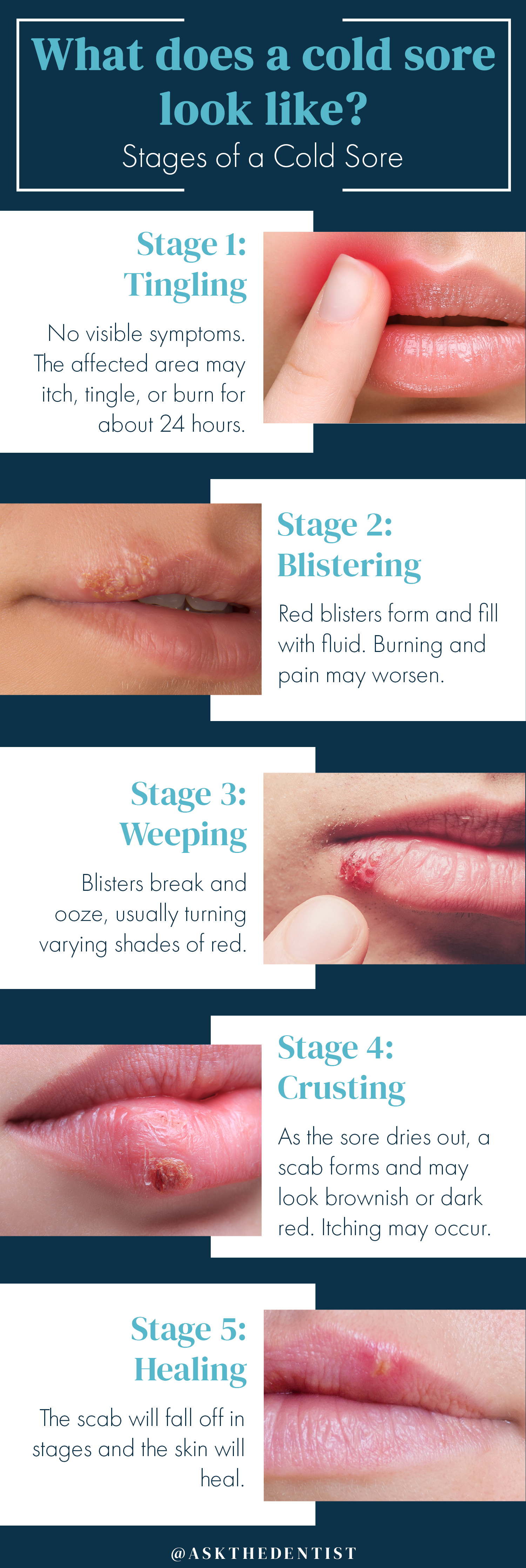 Blister on lip not deals cold sore