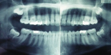 Wisdom Teeth Pictures Symptoms Surgery Pain Relief Ask The Dentist