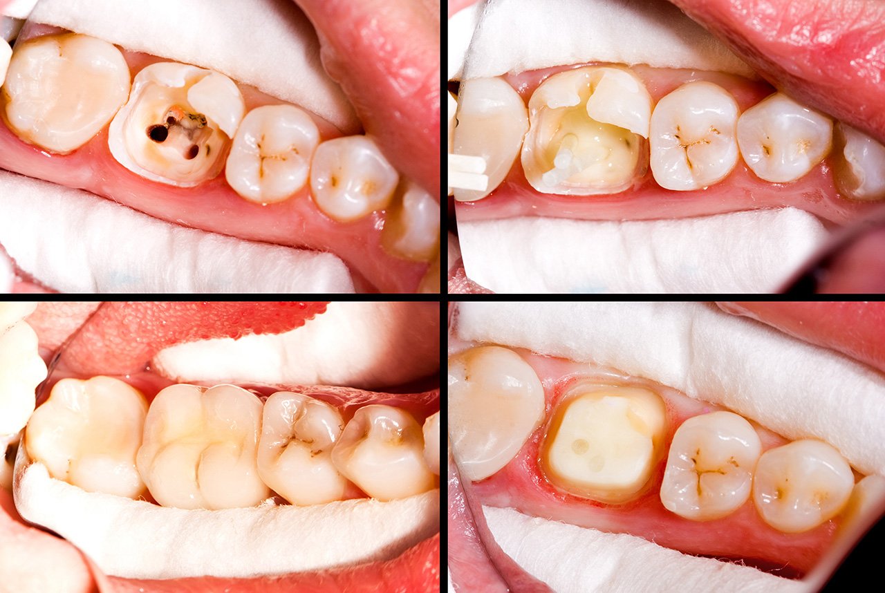 root canal before and after, root canal procedure, root canal steps