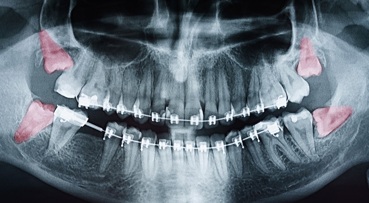 wisdom teeth x ray