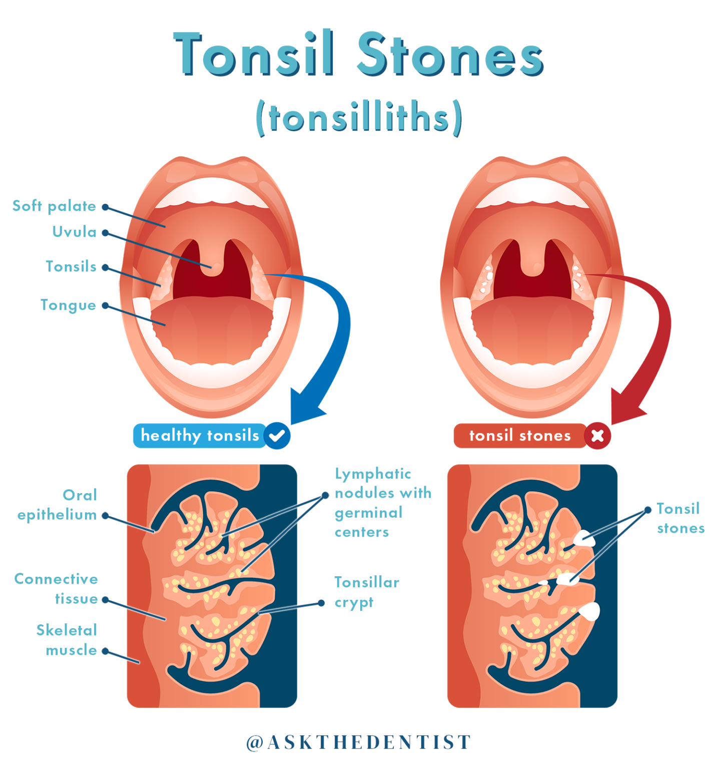 Cold Drinks and Tonsil Stones: Exploring the Relationship - NL Today