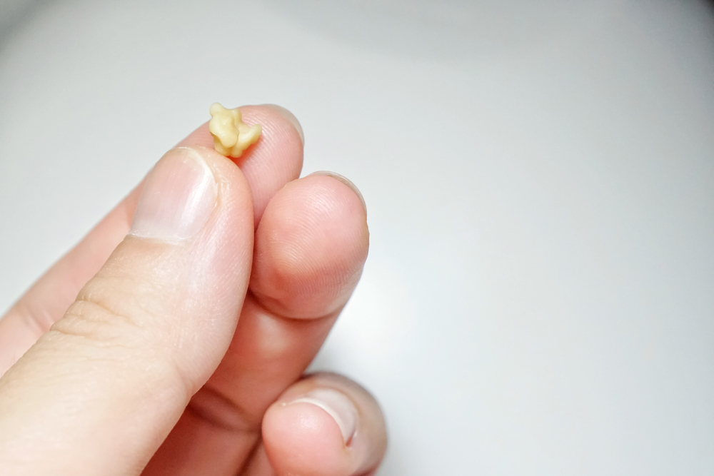 Tonsil Stones Archives Ask the Dentist